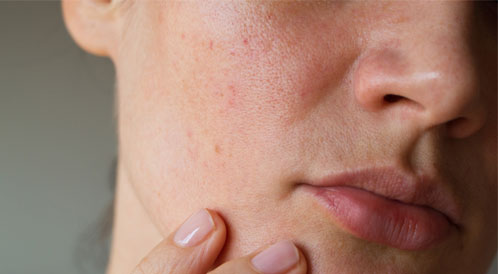 أفضل كريم لتهيج البشرة