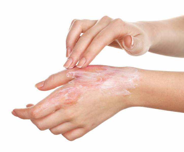 افضل كريم للحروق من الدرجة الثانية